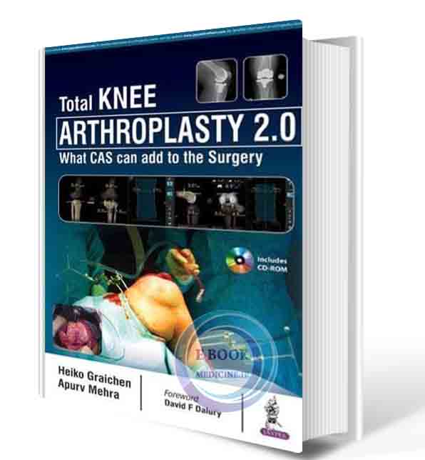 دانلود کتاب Total Knee Arthroplasty 2.0: What CAS can add to the Surgery 2021 (ORIGINAL PDF)